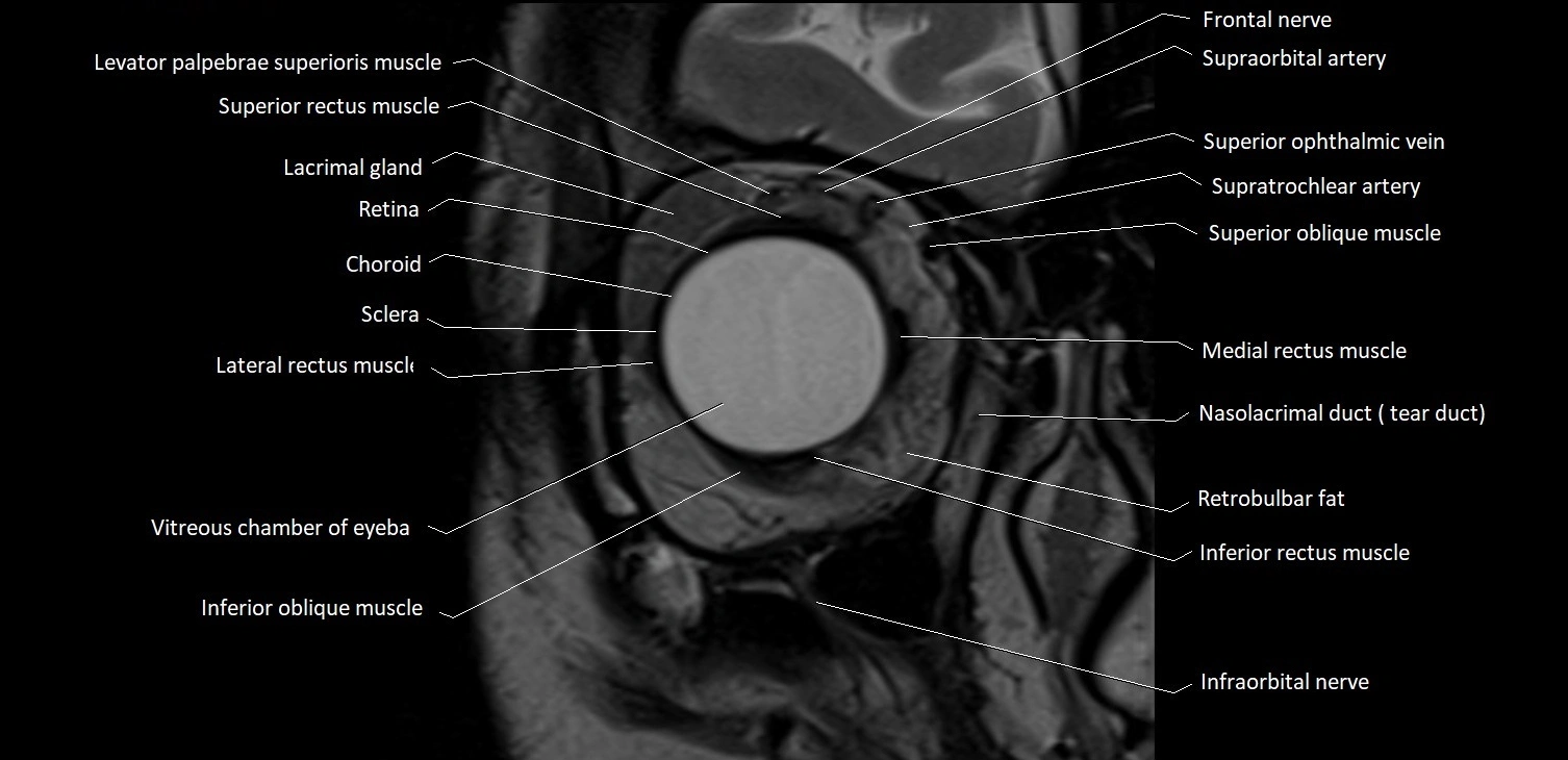 MRI Orbit coronal cross sectional anatomy image 5.webp